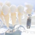 Implanty dentystyczne – czy mogą zastąpić prawdziwe zęby?