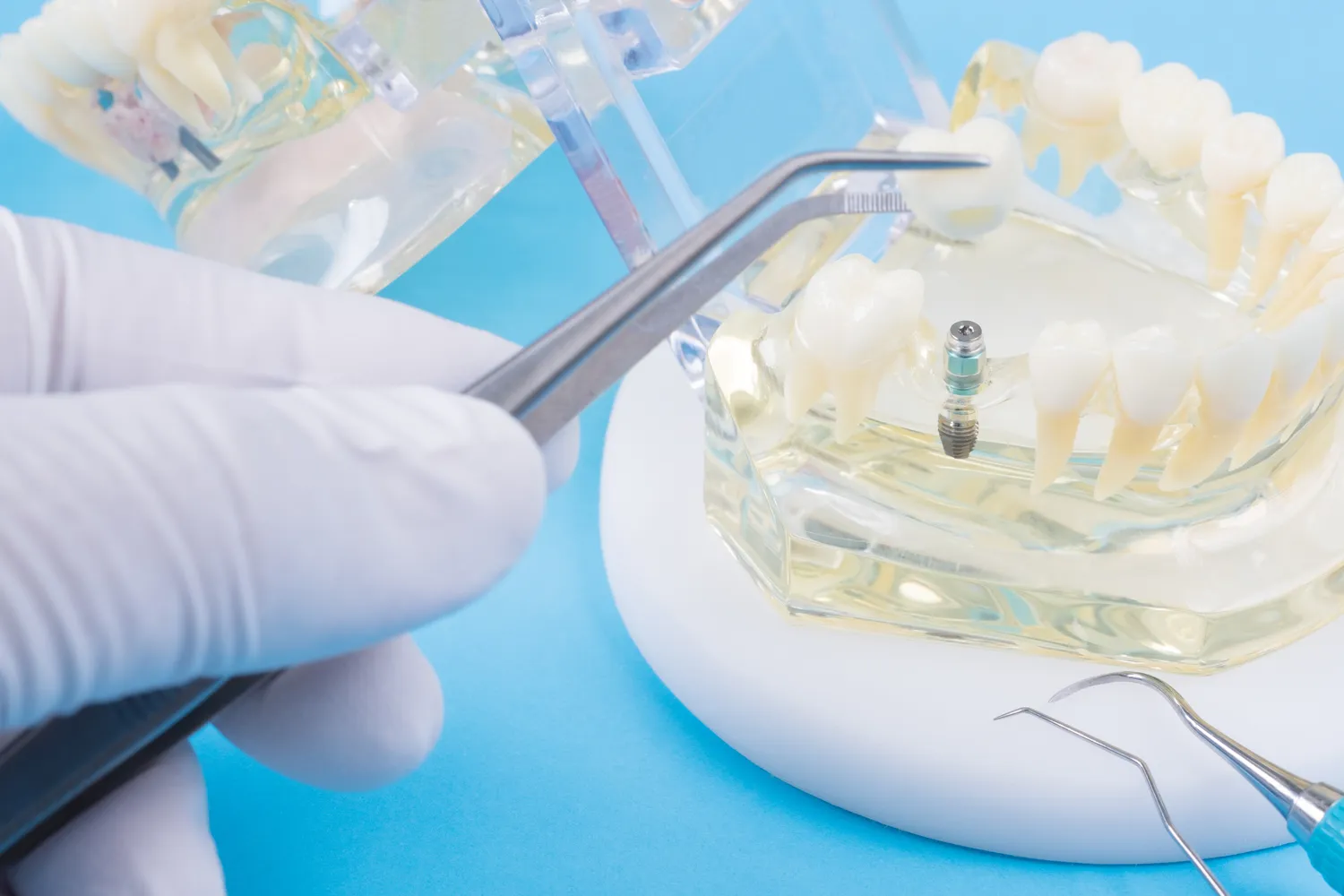 Implanty w jeden dzień Police